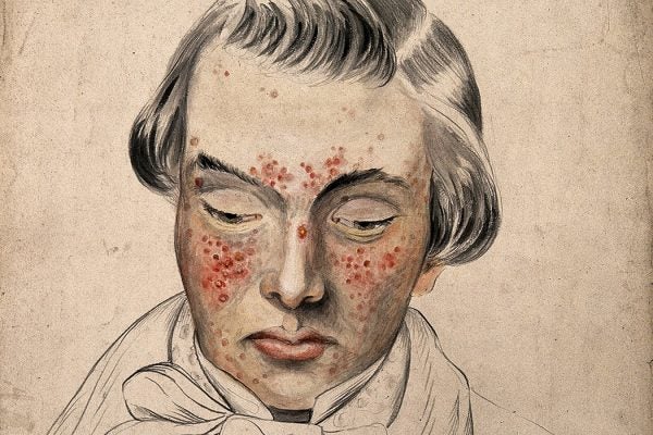 Illustration: Head of a man with a severe disease affecting his face by Christopher D' Alton, 1858

Source: https://bibliotheek.ehb.be:2090/stable/community.24834473