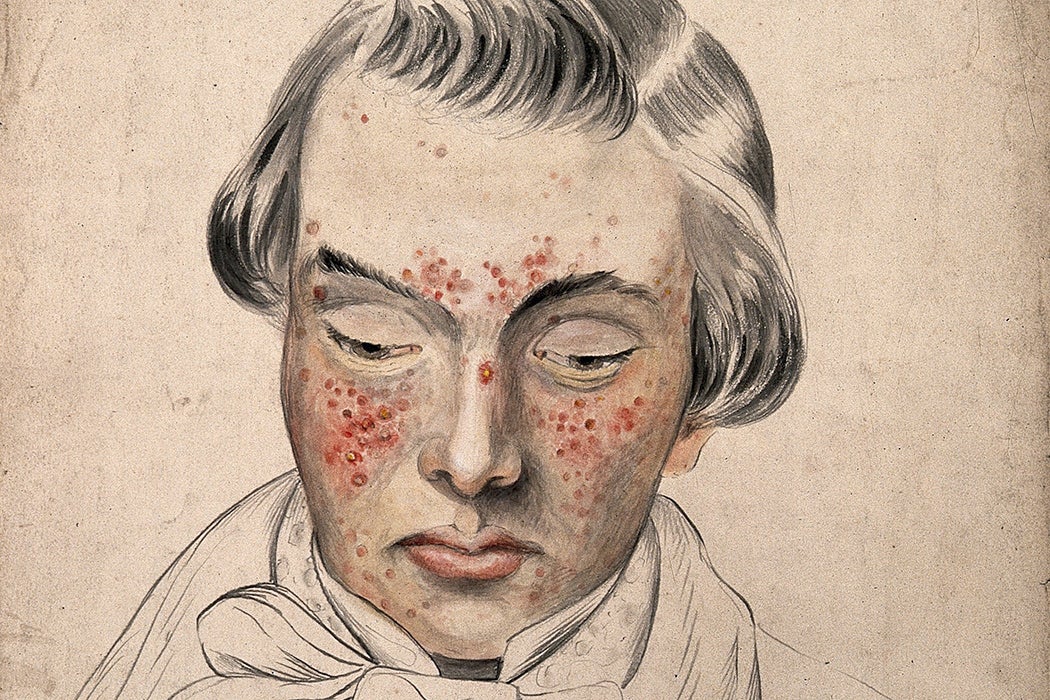 Illustration: Head of a man with a severe disease affecting his face by Christopher D' Alton, 1858

Source: https://bibliotheek.ehb.be:2090/stable/community.24834473