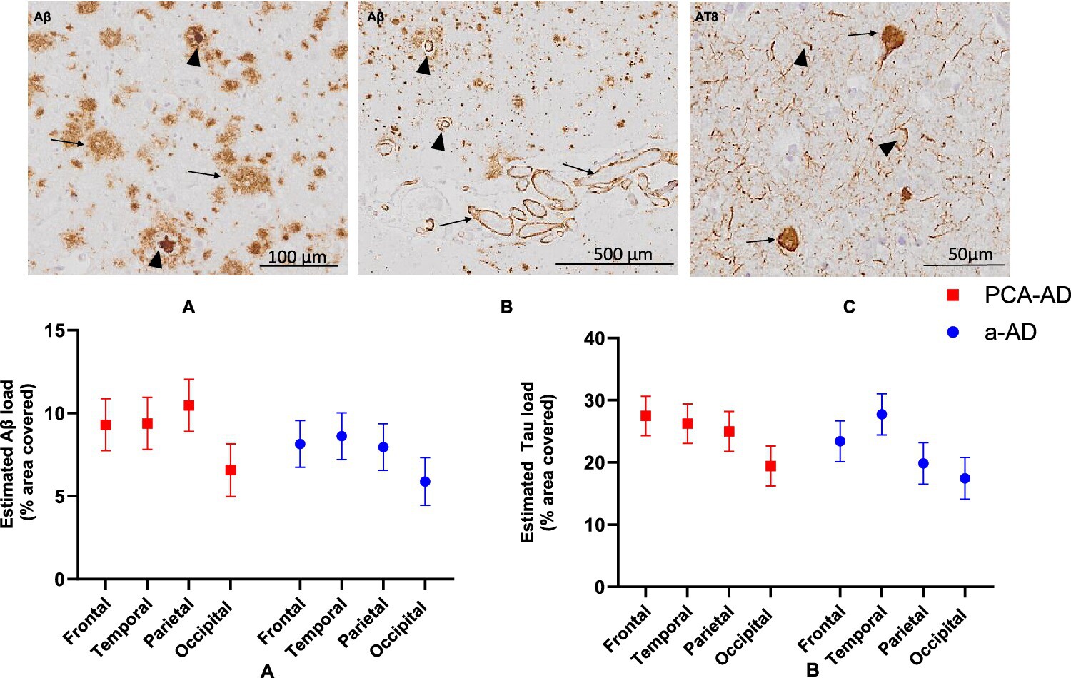 Pathological Characterisation of Posterior Cortical Atrophy in Comparison With Amnestic Alzheimer's Disease Issue 2, 2025